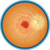 Wet AMD